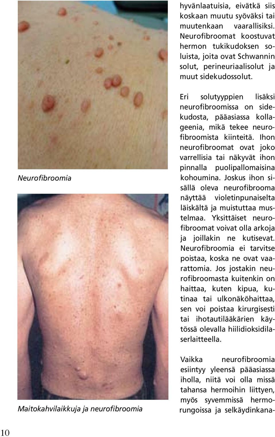 Neurofibroomia Maitokahvilaikkuja ja neurofibroomia Eri solutyyppien lisäksi neurofibroomissa on sidekudosta, pääasiassa kollageenia, mikä tekee neurofibroomista kiinteitä.