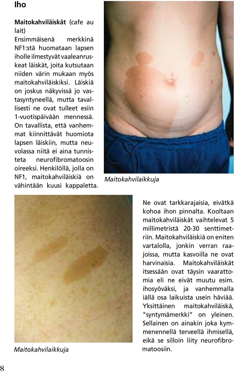 On tavallista, että vanhemmat kiinnittävät huomiota lapsen läiskiin, mutta neuvolassa niitä ei aina tunnisteta neurofibromatoosin oireeksi.