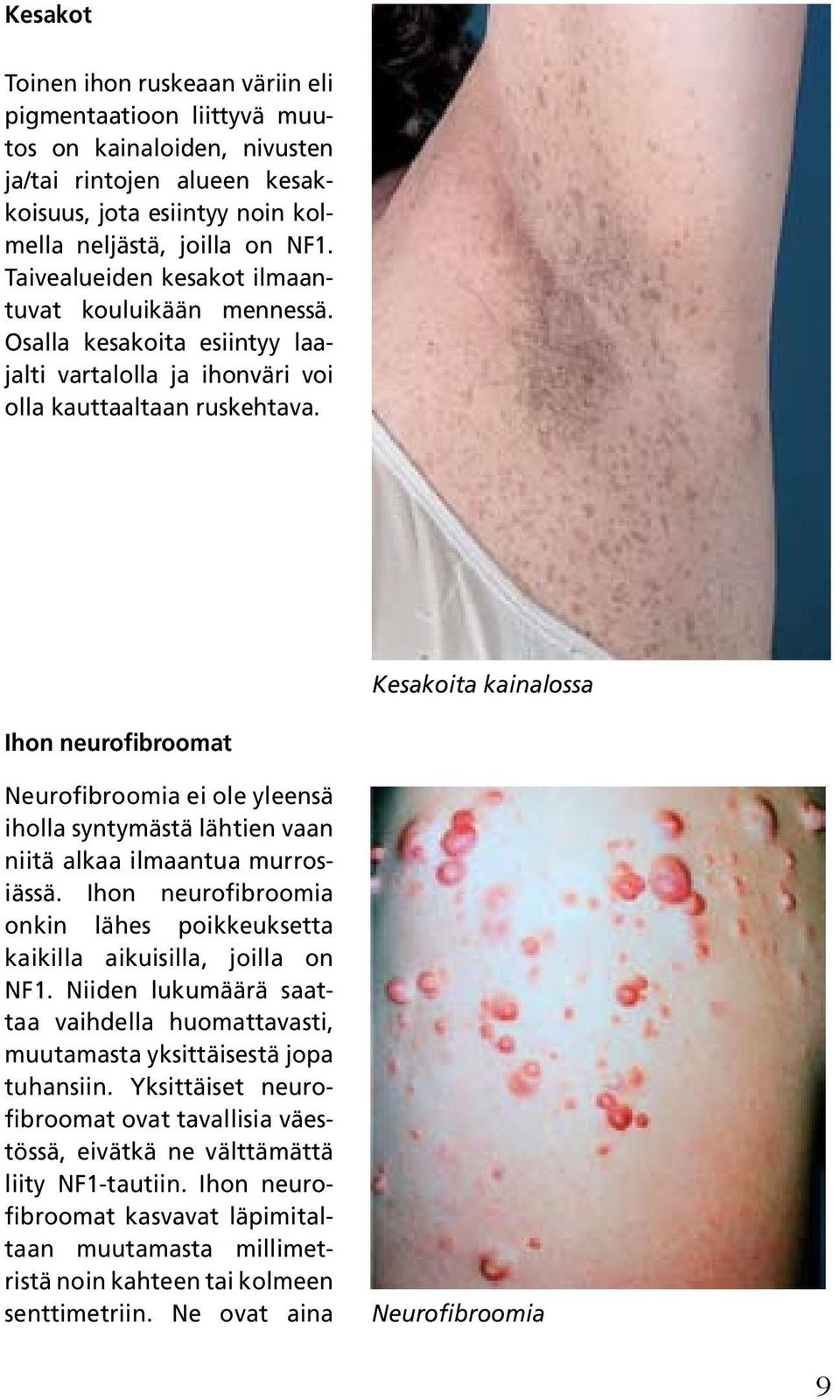 Kesakoita kainalossa Ihon neurofibroomat Neurofibroomia ei ole yleensä iholla syntymästä lähtien vaan niitä alkaa ilmaantua murrosiässä.