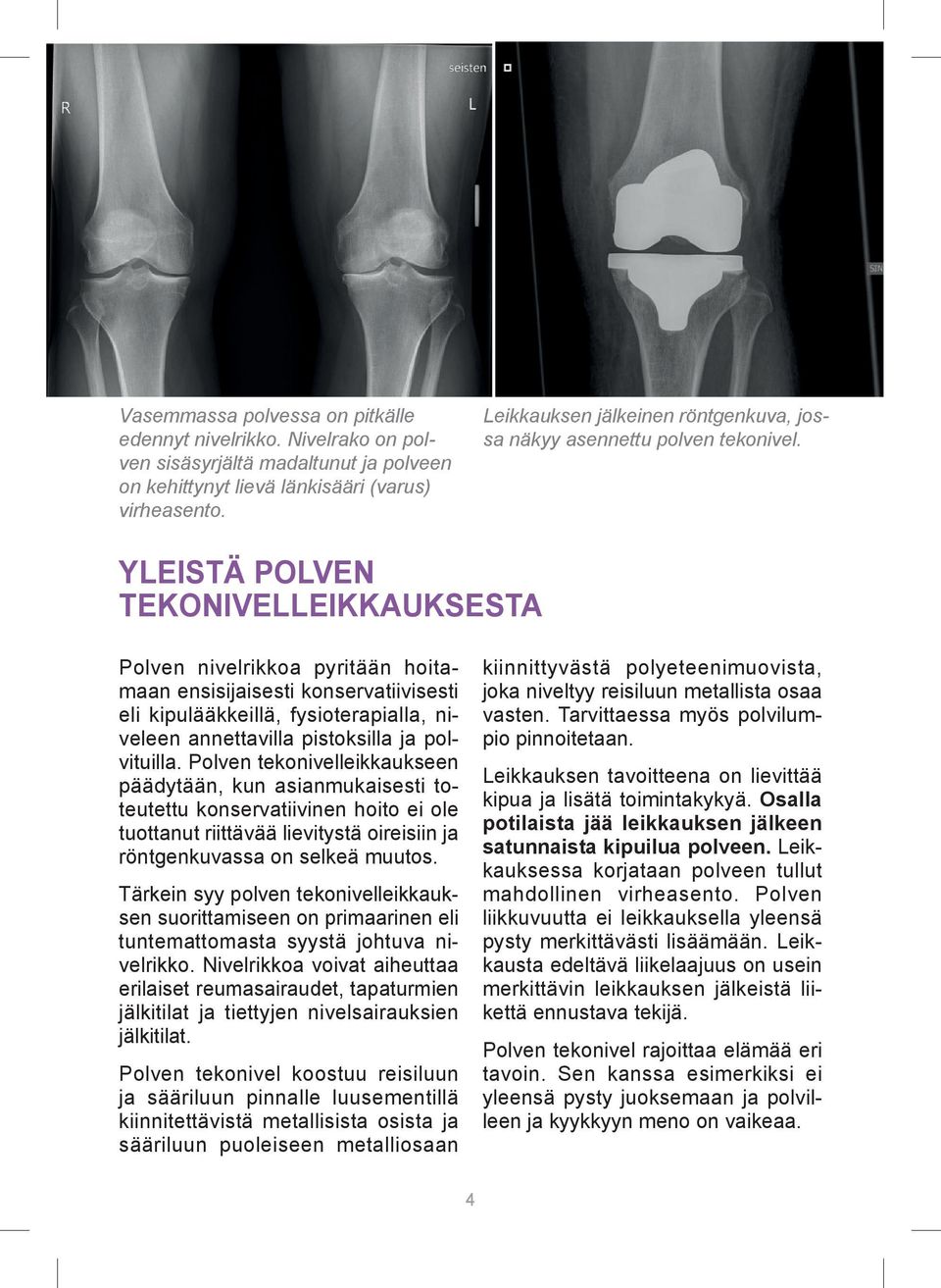 YLEISTÄ POLVEN TEKONIVELLEIKKAUKSESTA Polven nivelrikkoa pyritään hoitamaan ensisijaisesti konservatiivisesti eli kipulääkkeillä, fysioterapialla, niveleen annettavilla pistoksilla ja polvituilla.