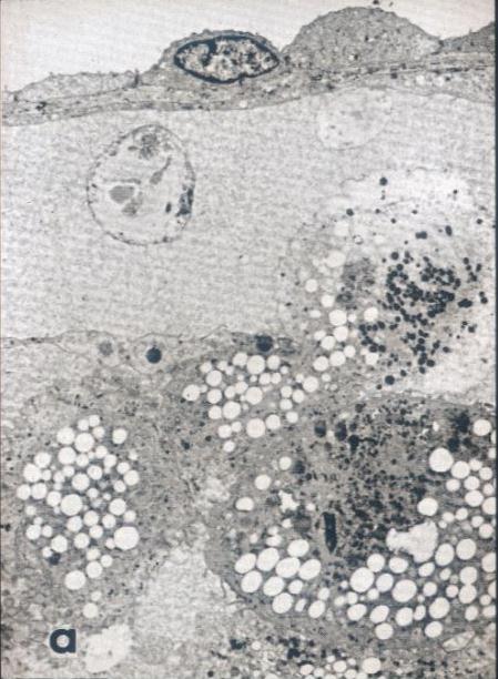 ATVB 19 (1999) 847 Rasvajuosteen synty Vaahtosolun muodostuminen Muuntunut Reseptorivälitteinen endosytoosi Scavenger receptor (jätereseptori) Endosomi/ Lysosomi ACEH Vaahtosolujen muodostuminen