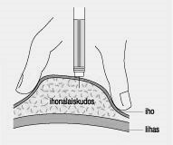 15 KUVA 5: Ihon poimuttaminen ja insuliinin pisto (Nikkanen 2011c). 4.4.5 Insuliinin imeytymiseen vaikuttavat tekijät Insuliinin siirtyessä ihonalaiseen rasvakudokseen insuliinikide liukenee.