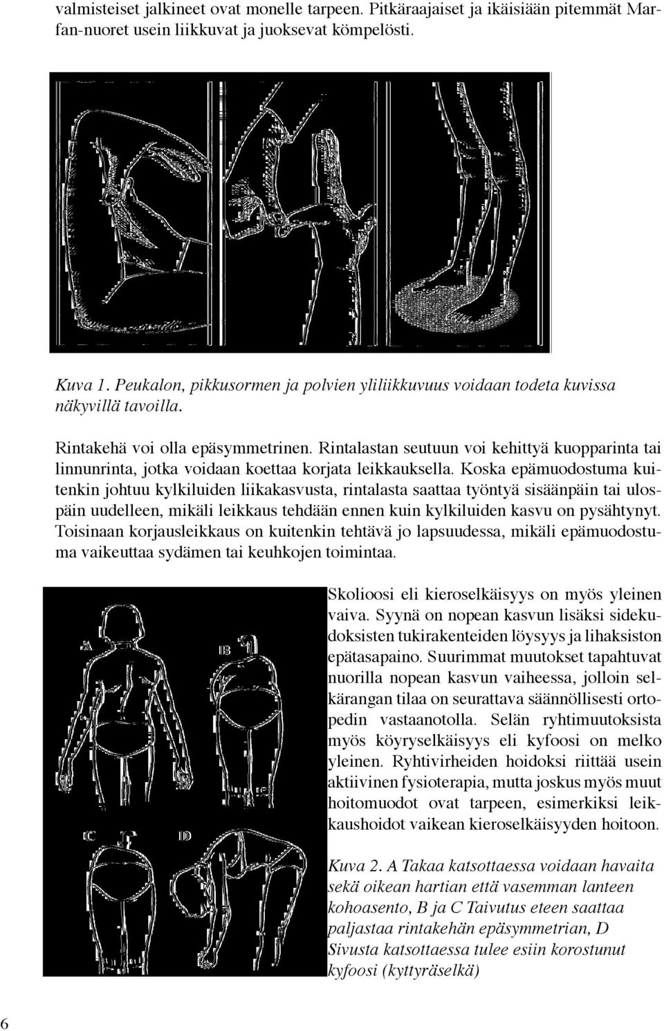 Rintalastan seutuun voi kehittyä kuopparinta tai linnunrinta, jotka voidaan koettaa korjata leikkauksella.