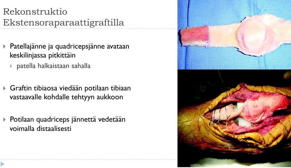 sahalla } Graftin tibiaosa viedään potilaan tibiaan vastaavalle