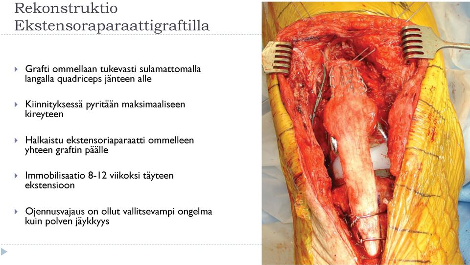 kireyteen Halkaistu ekstensoriaparaatti ommelleen yhteen graftin päälle Immobilisaatio