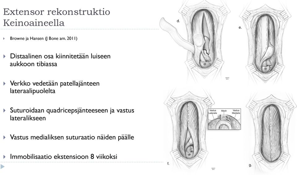 patellajänteen lateraalipuolelta } Suturoidaan quadricepsjänteeseen ja vastus