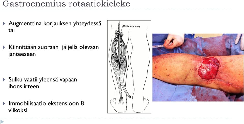 jäljellä olevaan jänteeseen } Sulku vaatii yleensä