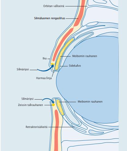 Kuivasilmäisyyteen voi liittyä myös luomenreunan tulehdus Kroonisesti tulehtunut luomenreuna vaatii aina parantuakseen pitkäaikaista ja säännöllistä hoitoa.