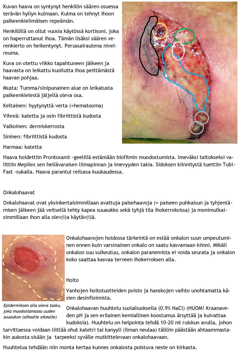 Musta: Tumma/sinipunainen alue on leikatusta palkeenkielestä jäljellä oleva osa.