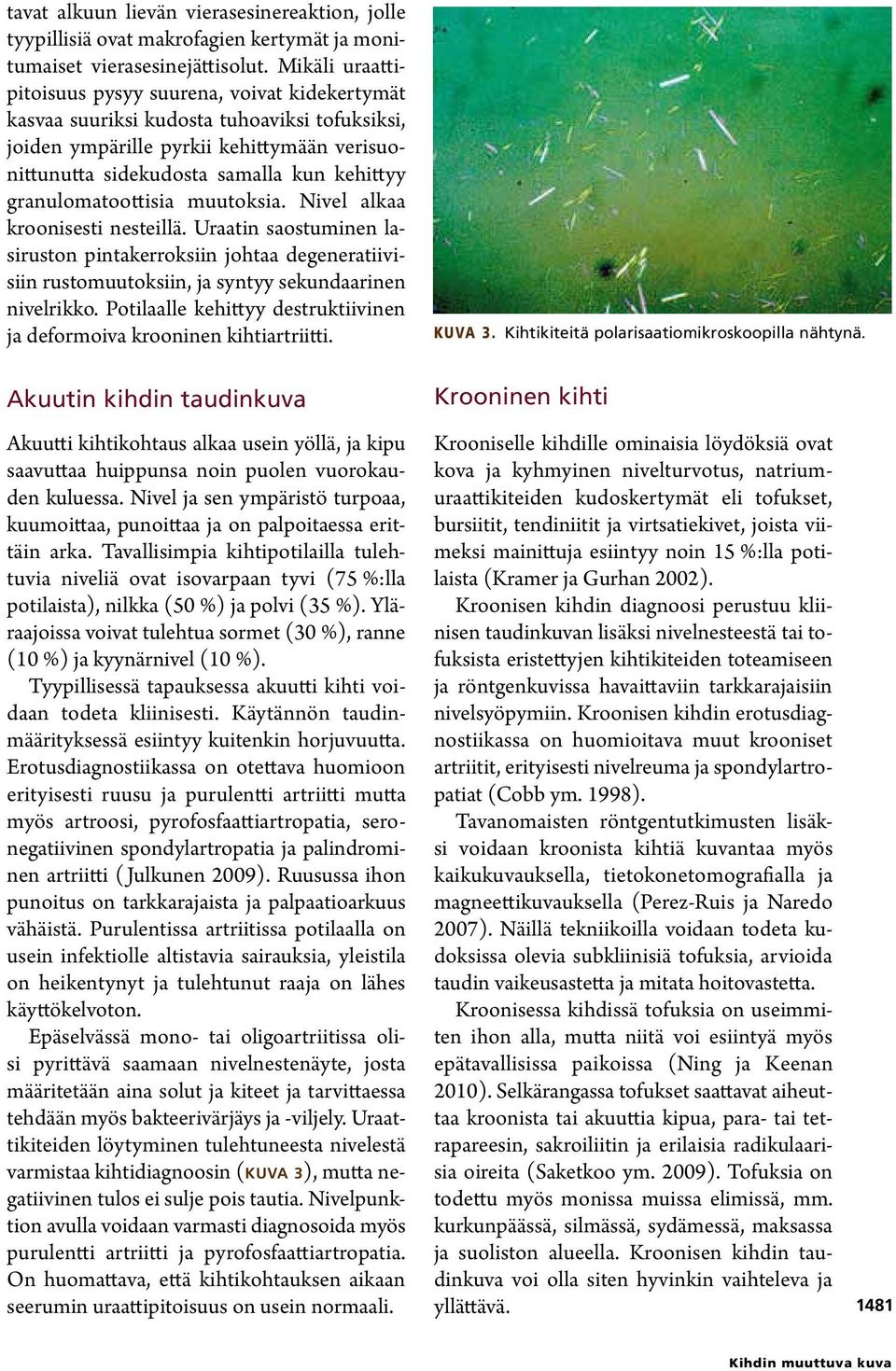 granulomatoottisia muutoksia. Nivel alkaa kroonisesti nesteillä. Uraatin saostuminen lasiruston pintakerroksiin johtaa degeneratiivisiin rustomuutoksiin, ja syntyy sekundaarinen nivelrikko.