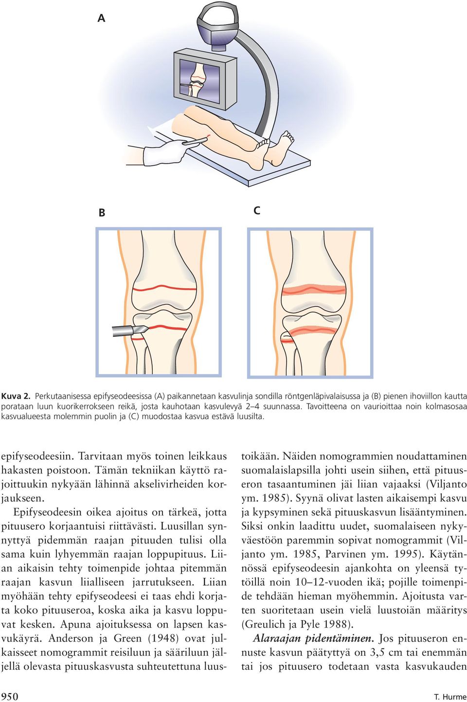 suunnassa. Tavoitteena on vaurioittaa noin kolmasosaa kasvualueesta molemmin puolin ja (C) muodostaa kasvua estävä luusilta. epifyseodeesiin. Tarvitaan myös toinen leikkaus hakasten poistoon.