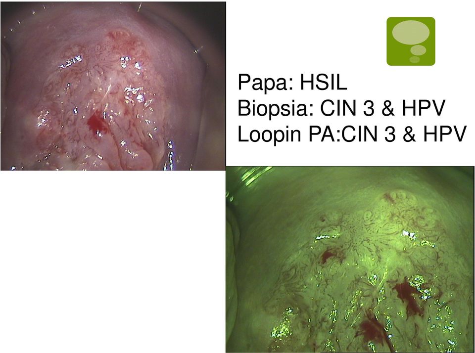 3 & HPV