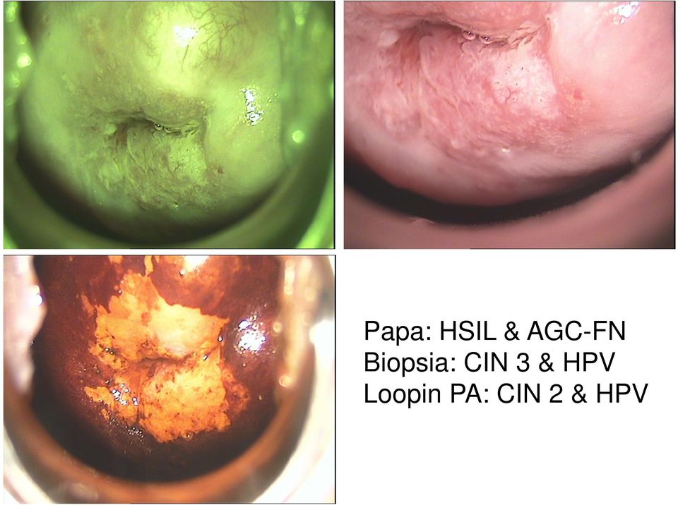 CIN 3 & HPV