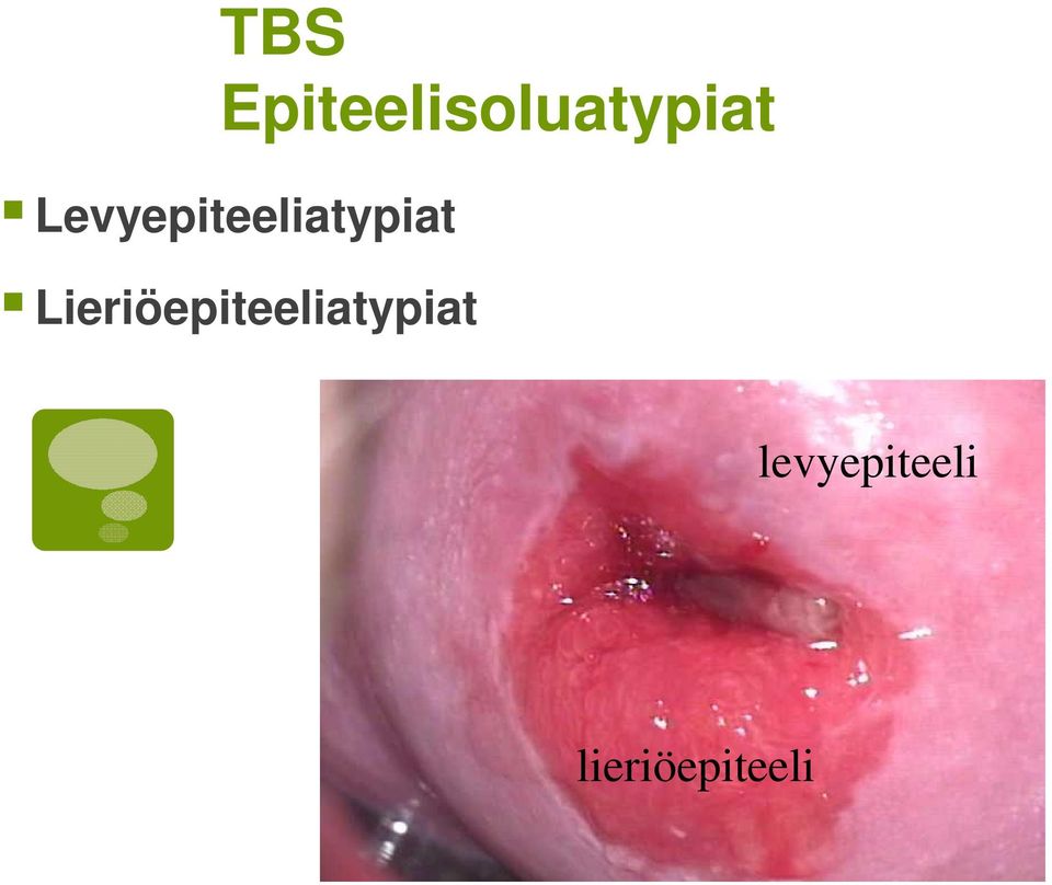 Lieriöepiteeliatypiat