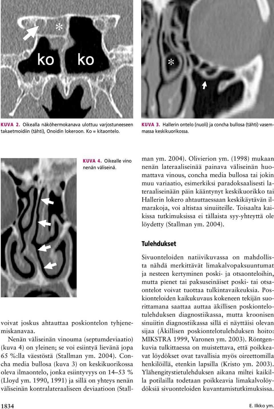 Nenän väliseinän vinouma (septumdeviaatio) (kuva 4) on yleinen; se voi esiintyä lievänä jopa 65 %:lla väestöstä (Stallman ym. 2004).