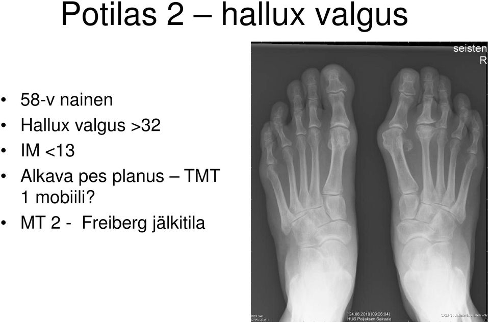 <13 Alkava pes planus TMT 1