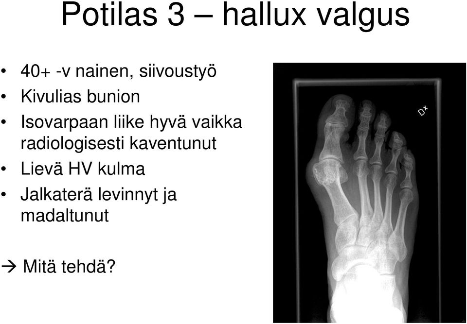 hyvä vaikka radiologisesti kaventunut Lievä