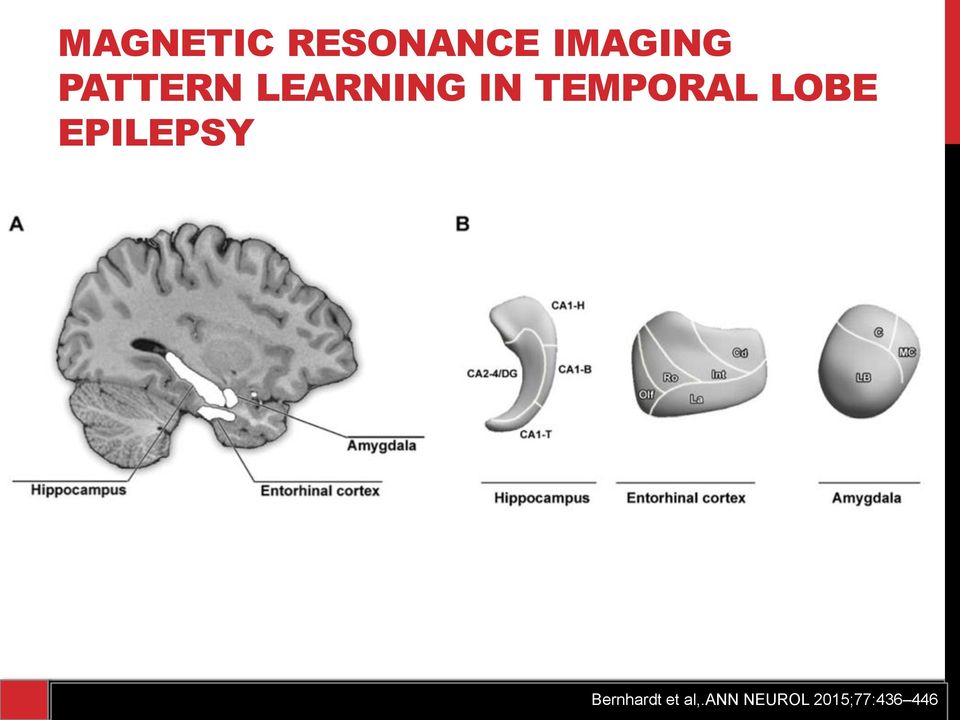 LOBE EPILEPSY Bernhardt et