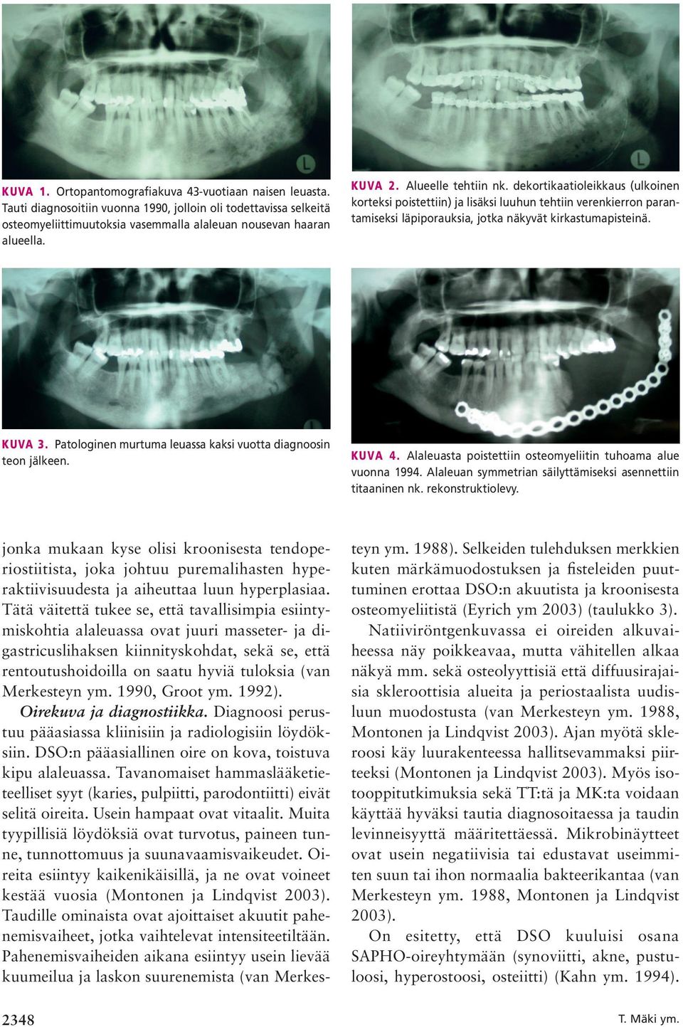 Patologinen murtuma leuassa kaksi vuotta diagnoosin teon jälkeen. KUVA 4. Alaleuasta poistettiin osteomyeliitin tuhoama alue vuonna 1994. Alaleuan symmetrian säilyttämiseksi asennettiin titaaninen nk.