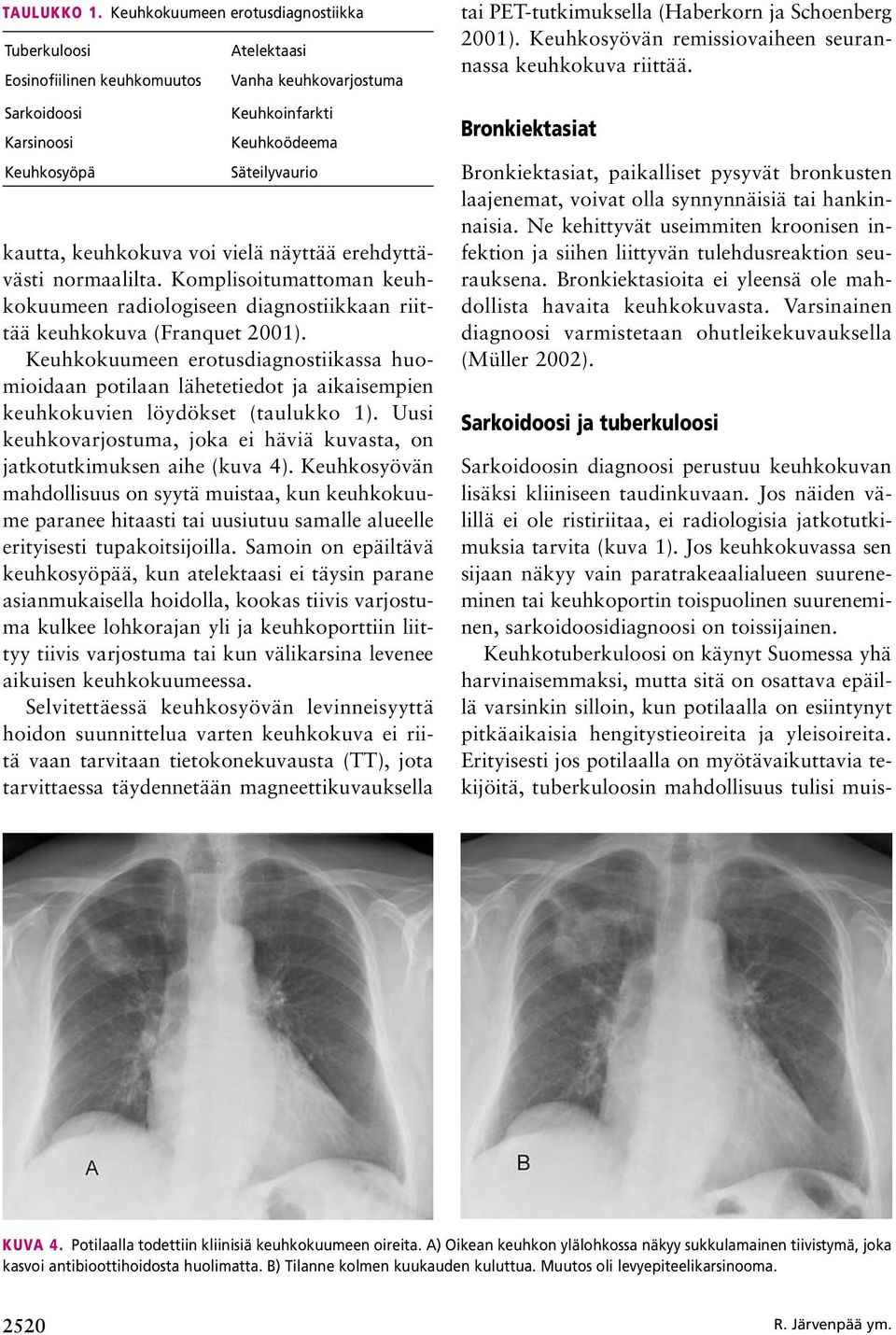 keuhkokuva voi vielä näyttää erehdyttävästi normaalilta. Komplisoitumattoman keuhkokuumeen radiologiseen diagnostiikkaan riittää keuhkokuva (Franquet 2001).
