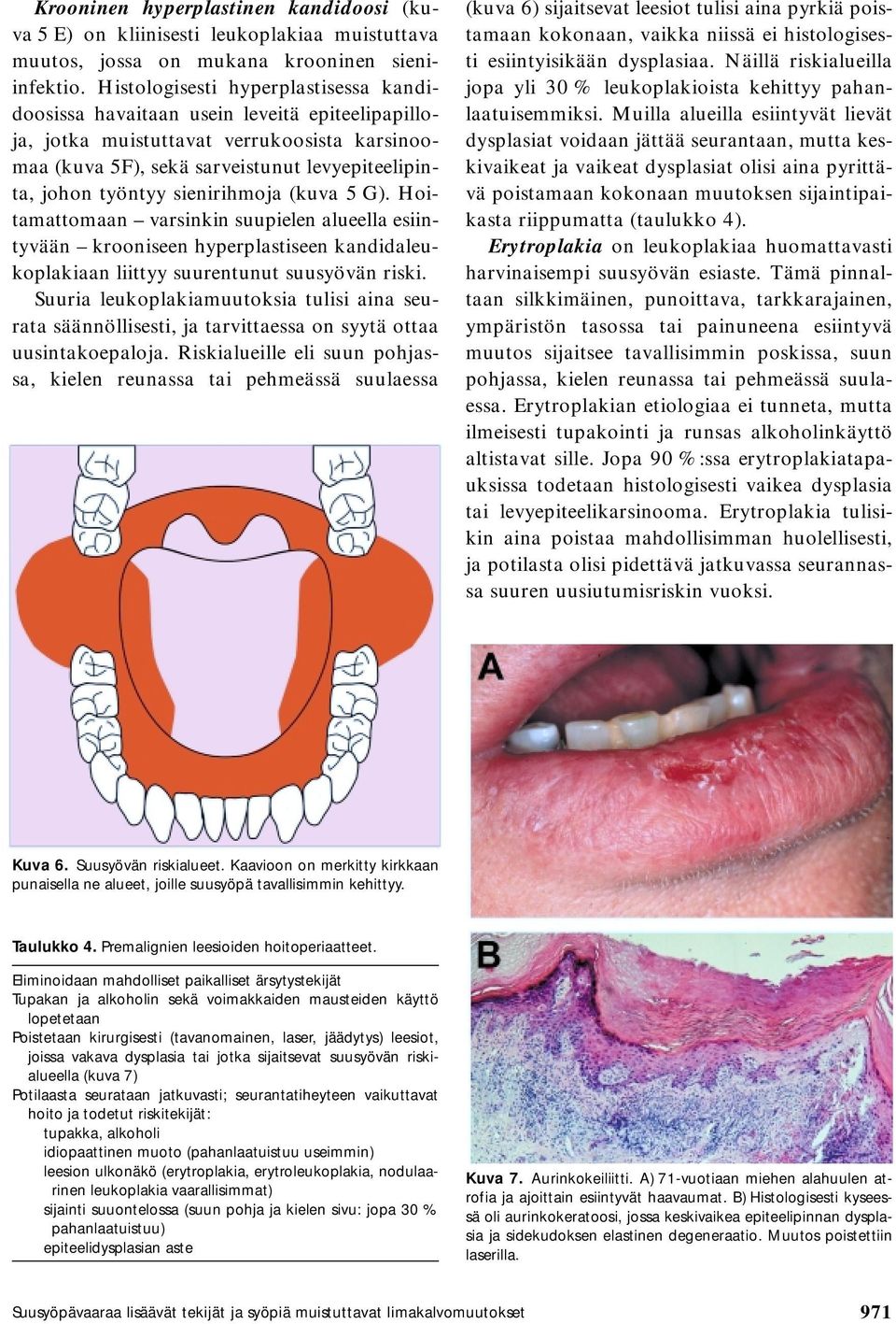 sienirihmoja (kuva 5 G). Hoitamattomaan varsinkin suupielen alueella esiintyvään krooniseen hyperplastiseen kandidaleukoplakiaan liittyy suurentunut suusyövän riski.