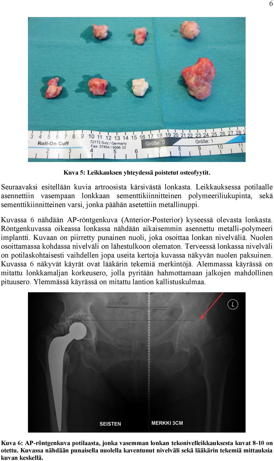 Kuvassa 6 nähdään AP-röntgenkuva (Anterior-Posterior) kyseessä olevasta lonkasta. Röntgenkuvassa oikeassa lonkassa nähdään aikaisemmin asennettu metalli-polymeeri implantti.