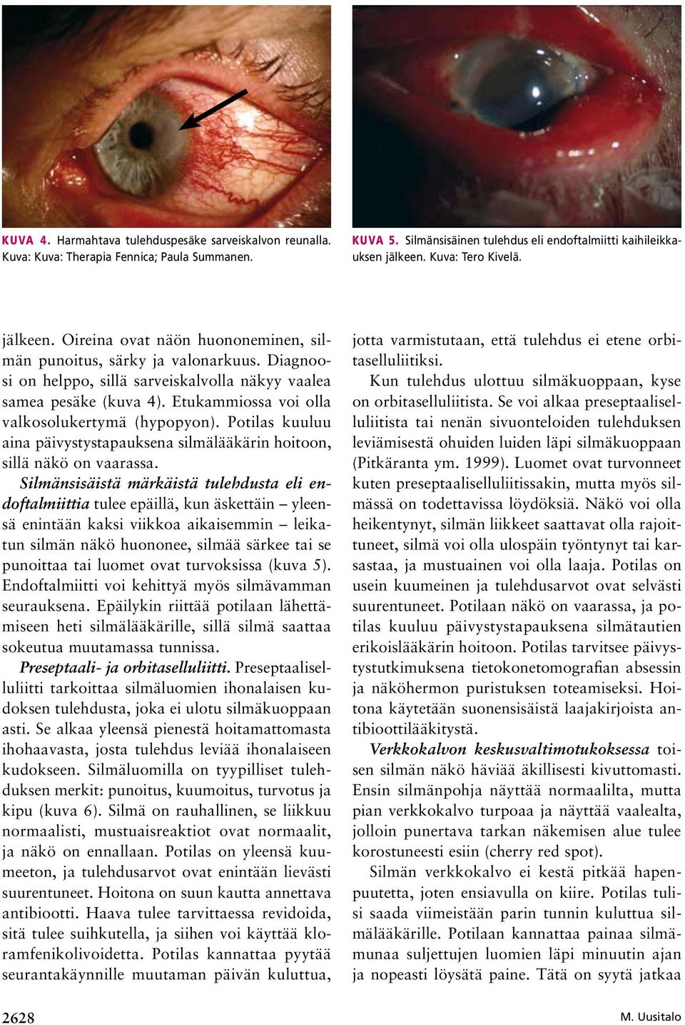 Etukammiossa voi olla valkosolukertymä (hypopyon). Potilas kuuluu aina päivystystapauksena silmälääkärin hoitoon, sillä näkö on vaarassa.