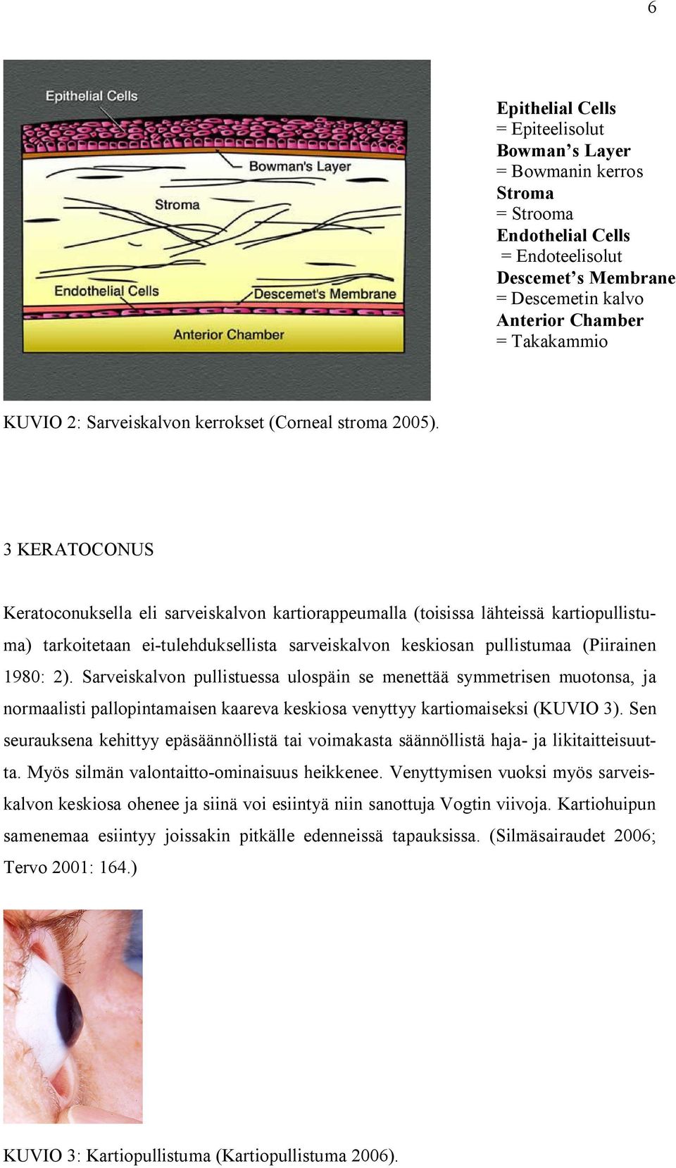 3 KERATOCONUS Keratoconuksella eli sarveiskalvon kartiorappeumalla (toisissa lähteissä kartiopullistuma) tarkoitetaan ei-tulehduksellista sarveiskalvon keskiosan pullistumaa (Piirainen 1980: 2).