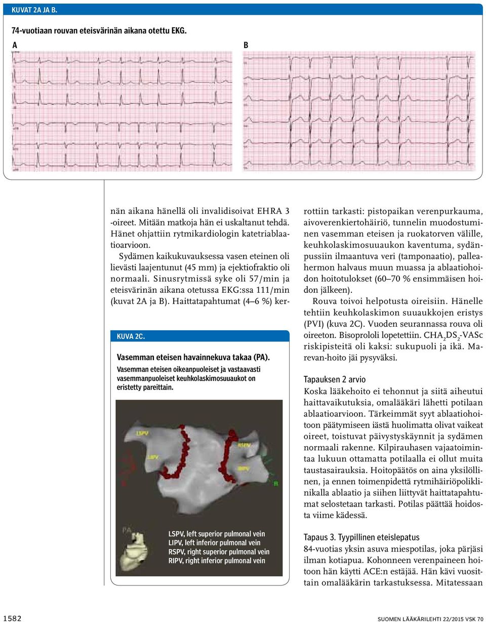 LSPV, left superior pulmonal vein LIPV, left inferior pulmonal vein RSPV, right superior pulmonal vein RIPV, right inferior pulmonal vein nän aikana hänellä oli invalidisoivat EHRA 3 -oireet.