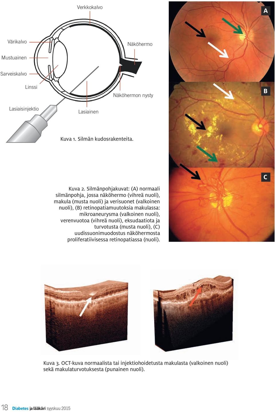 mikroaneurysma (valkoinen nuoli), verenvuotoa (vihreä nuoli), eksudaatiota ja turvotusta (musta nuoli), (C) uudissuonimuodostus näköhermosta proliferatiivisessa