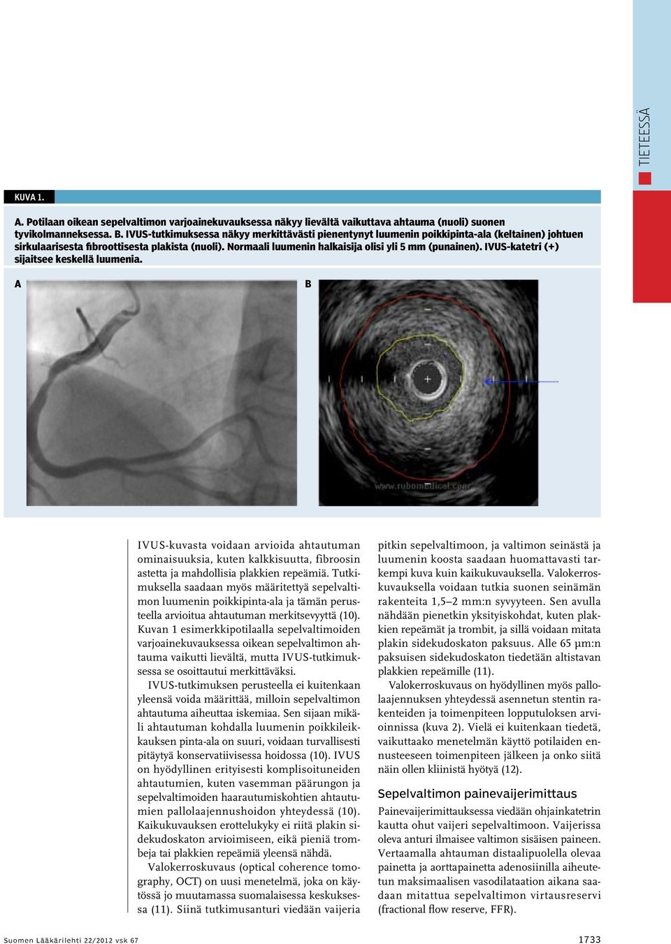 IVUS-katetri (+) sijaitsee keskellä luumenia. A B IVUS-kuvasta voidaan arvioida ahtautuman ominaisuuksia, kuten kalkkisuutta, fibroosin astetta ja mahdollisia plakkien repeämiä.