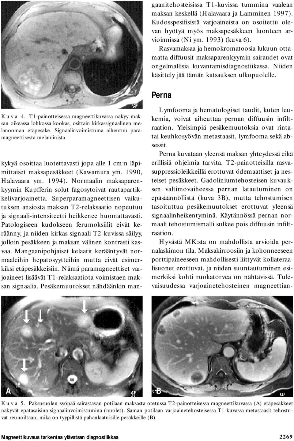 Perna K u v a 4. T1-painotteisessa magneettikuvassa näkyy maksan oikeassa lohkossa kookas, osittain kirkassignaalinen melanooman etäpesäke.