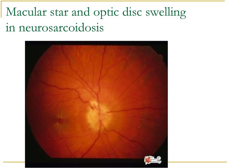 disc swelling