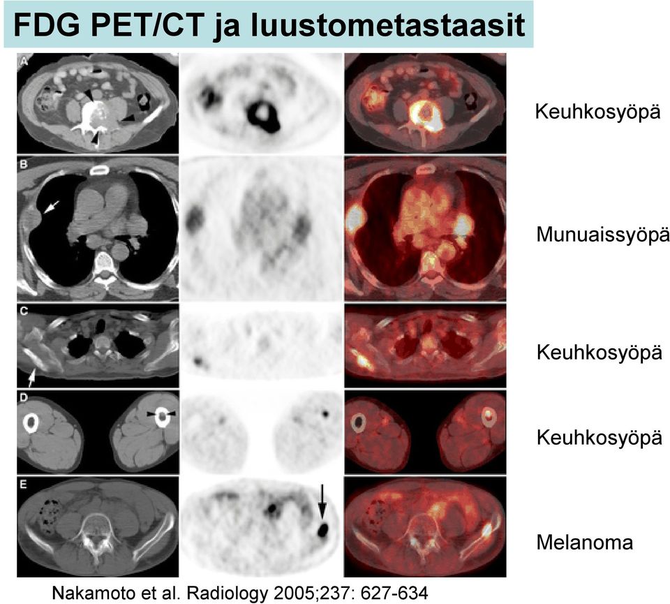 Keuhkosyöpä Keuhkosyöpä Melanoma