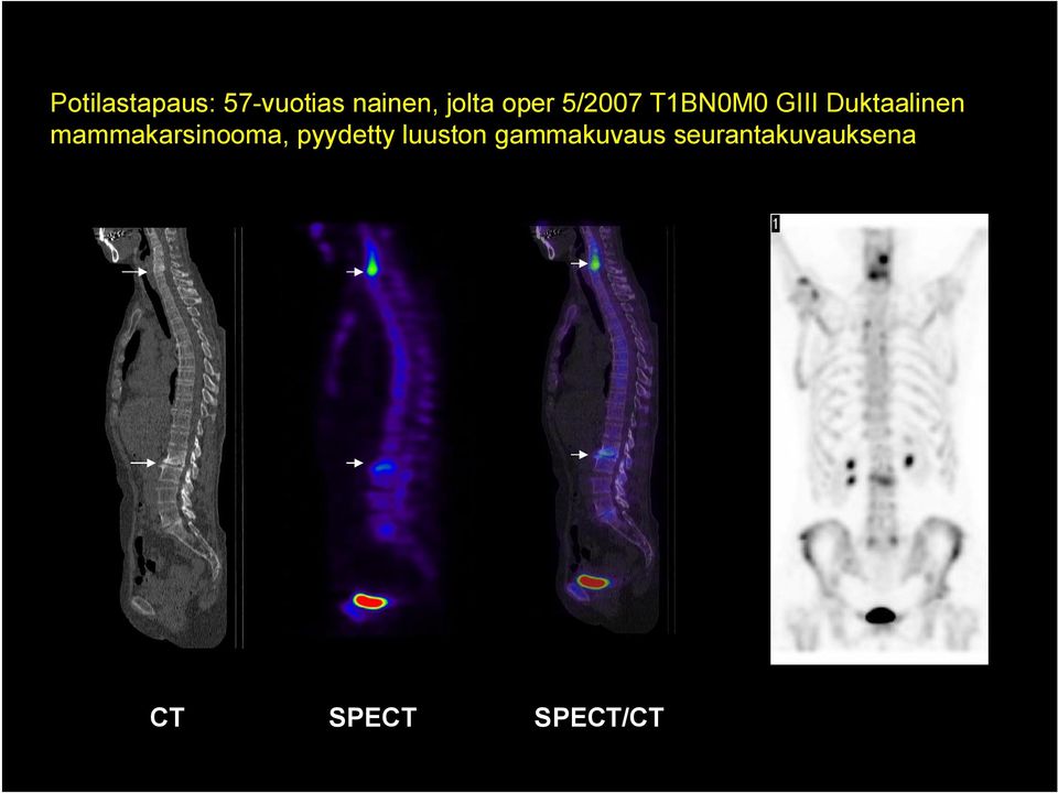 mammakarsinooma, pyydetty luuston