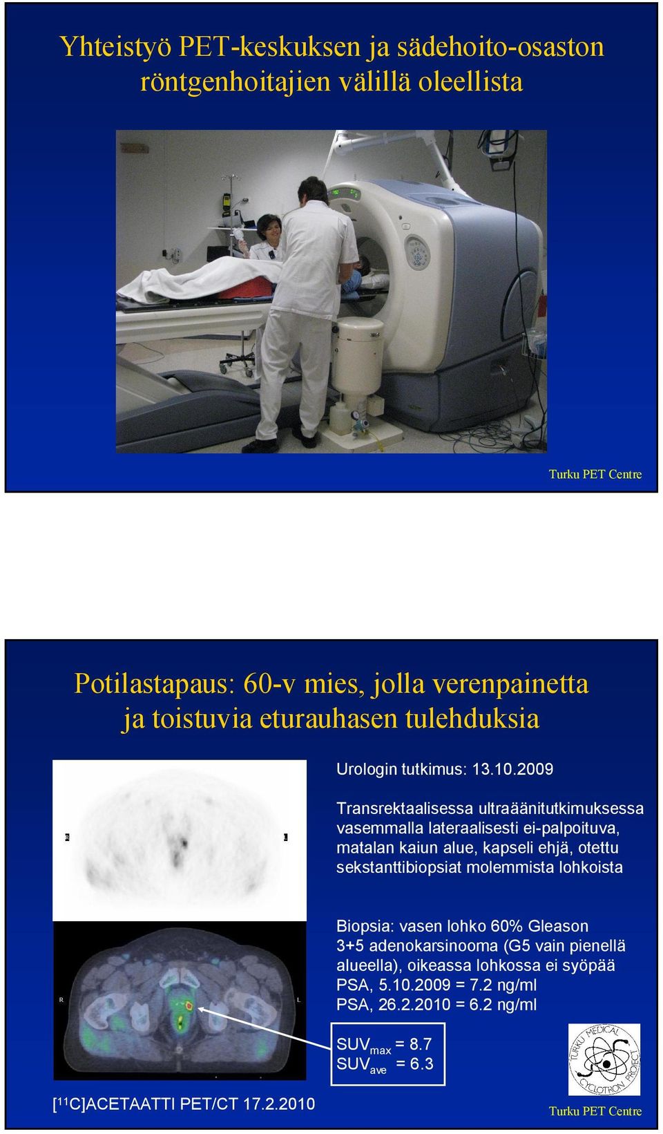 2009 Transrektaalisessa ultraäänitutkimuksessa vasemmalla lateraalisesti ei-palpoituva, matalan kaiun alue, kapseli ehjä, otettu