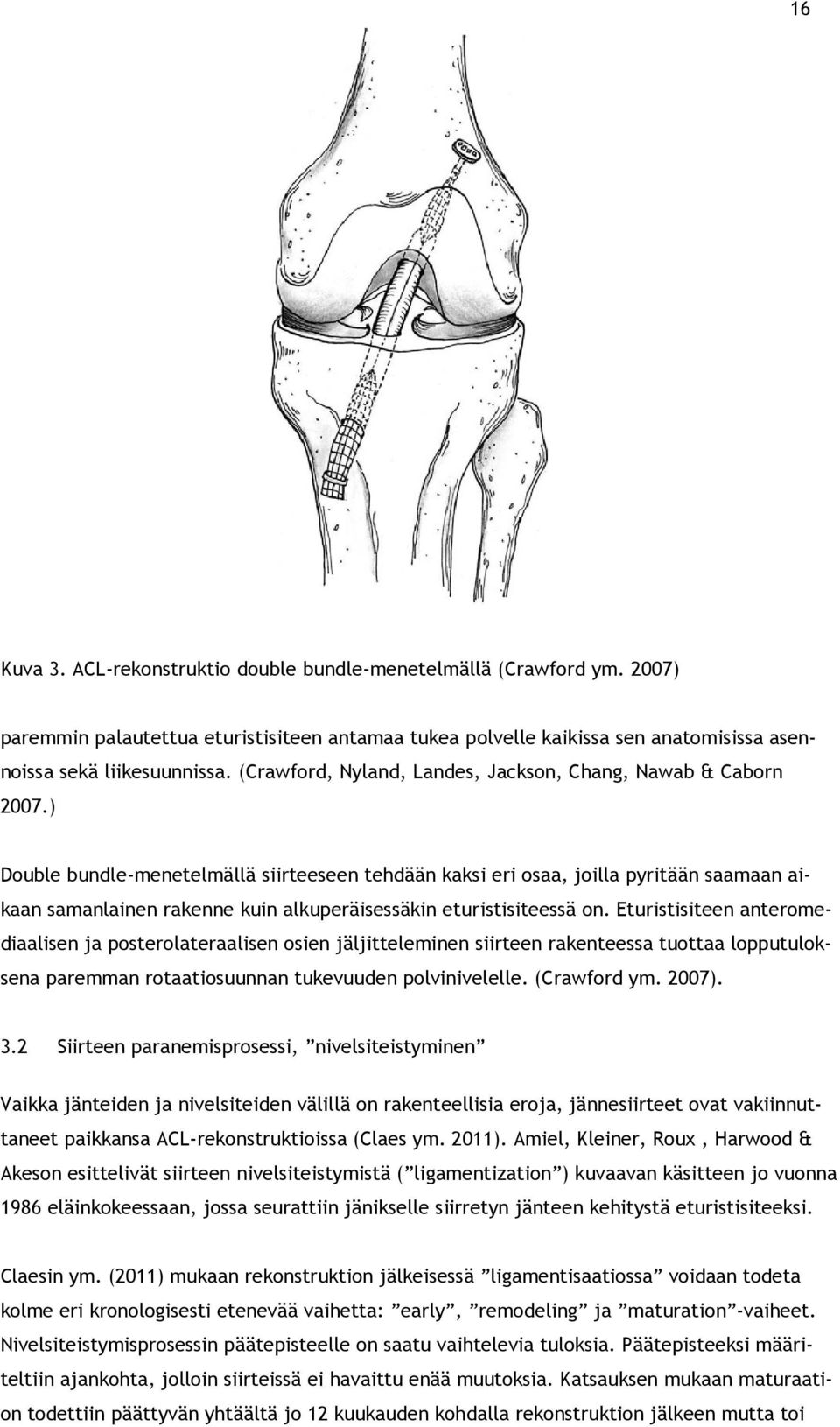 ) Double bundle-menetelmällä siirteeseen tehdään kaksi eri osaa, joilla pyritään saamaan aikaan samanlainen rakenne kuin alkuperäisessäkin eturistisiteessä on.