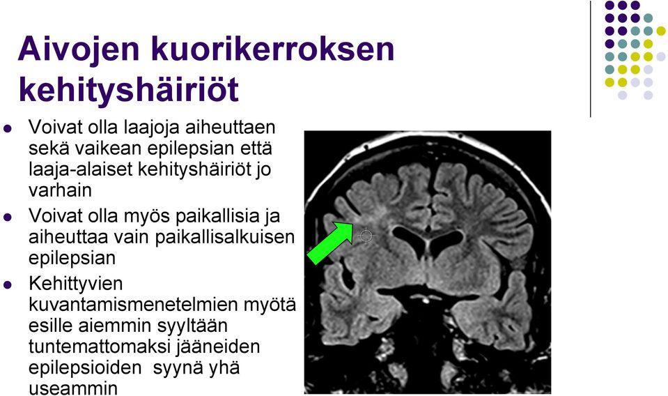 paikallisia ja aiheuttaa vain paikallisalkuisen epilepsian Kehittyvien