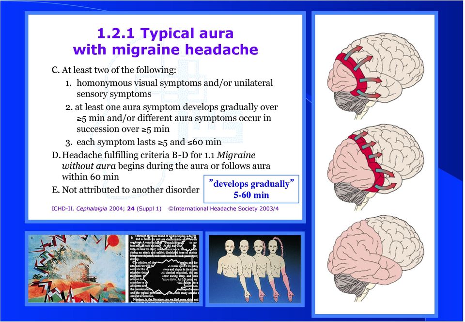 at least one aura symptom develops gradually over 5 min and/or different aura symptoms occur in succession over 5 min 3.