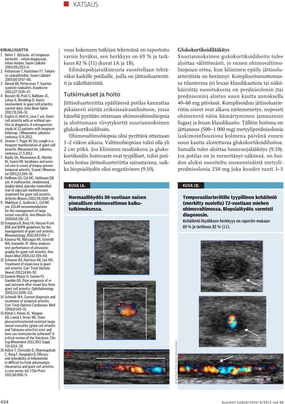 Aortic involvement in giant cell arteritis: current data. Joint Bone Spine 2011;78:246 51. 5 Espitia O, Néel A, Leux C ym. Giant cell arteritis with or without aortitis at diagnosis.