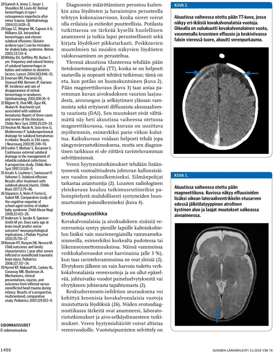 30 Whitby EH, Griffiths PD, Rutter S ym. Frequency and natural history of subdural haemorrhages in babies and relation to obstetric factors. Lancet 2004;363:846 51.