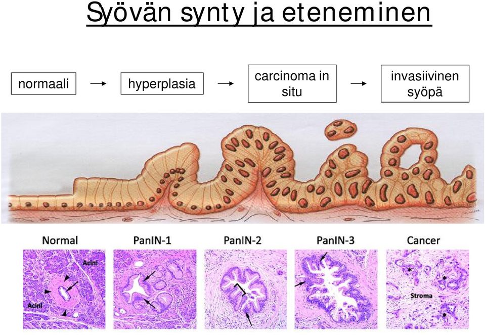 hyperplasia