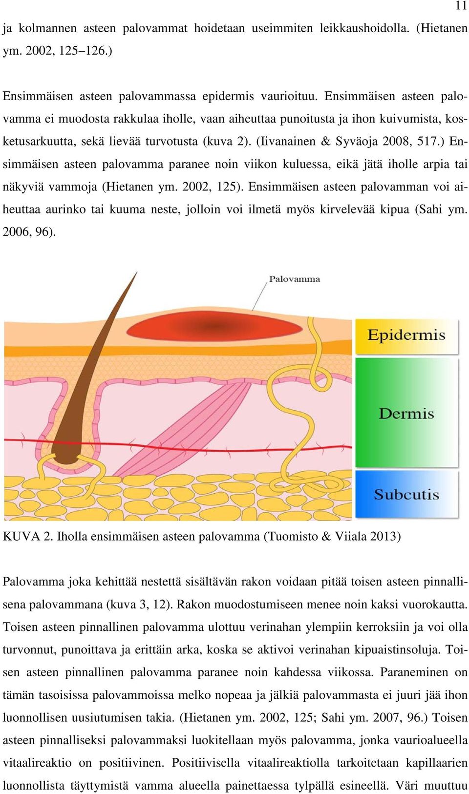 ) Ensimmäisen asteen palovamma paranee noin viikon kuluessa, eikä jätä iholle arpia tai näkyviä vammoja (Hietanen ym. 2002, 125).