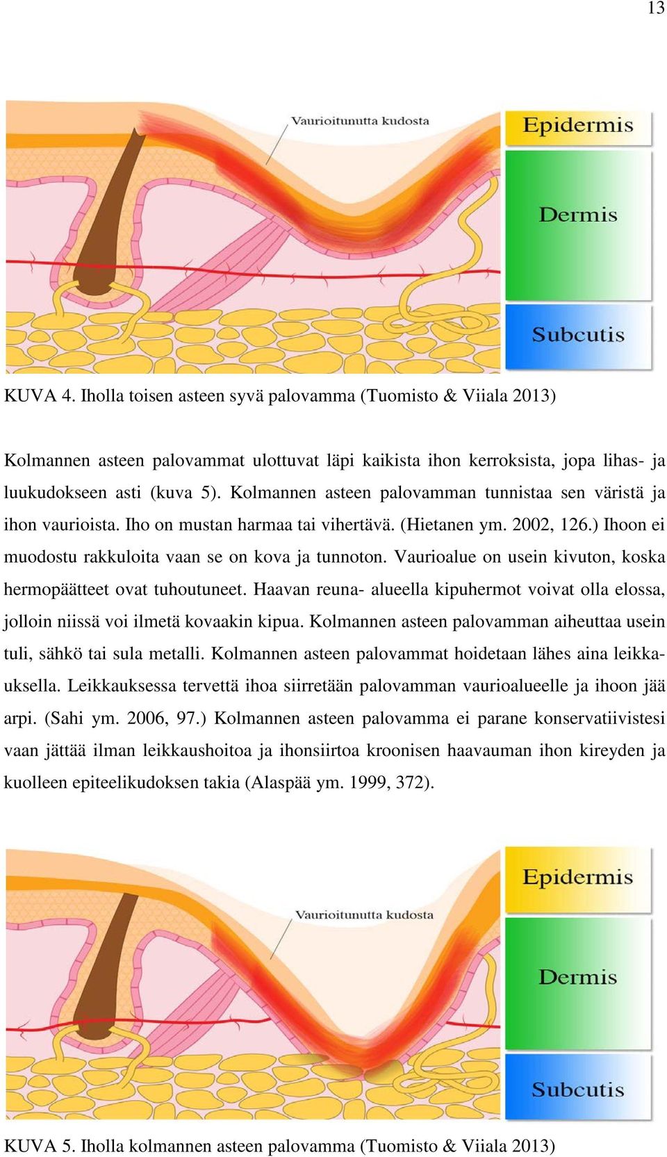 Vaurioalue on usein kivuton, koska hermopäätteet ovat tuhoutuneet. Haavan reuna- alueella kipuhermot voivat olla elossa, jolloin niissä voi ilmetä kovaakin kipua.