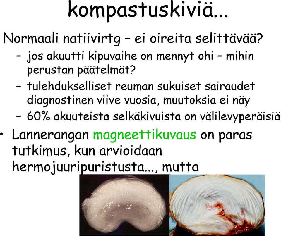 tulehdukselliset reuman sukuiset sairaudet diagnostinen viive vuosia, muutoksia ei näy