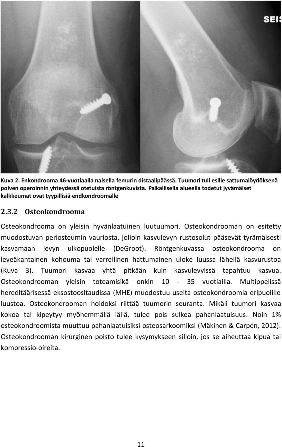 Osteokondrooman on esitetty muodostuvan periosteumin vauriosta, jolloin kasvulevyn rustosolut pääsevät tyrämäisesti kasvamaan levyn ulkopuolelle (DeGroot).