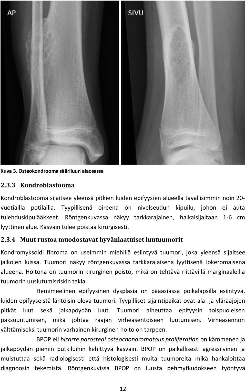 4 Muut rustoa muodostavat hyvänlaatuiset luutuumorit Kondromyksoidi fibroma on useimmin miehillä esiintyvä tuumori, joka yleensä sijaitsee jalkojen luissa.