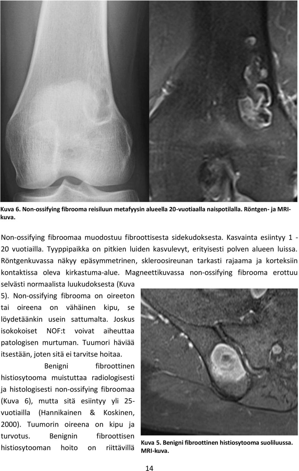 Röntgenkuvassa näkyy epäsymmetrinen, skleroosireunan tarkasti rajaama ja korteksiin kontaktissa oleva kirkastuma-alue.