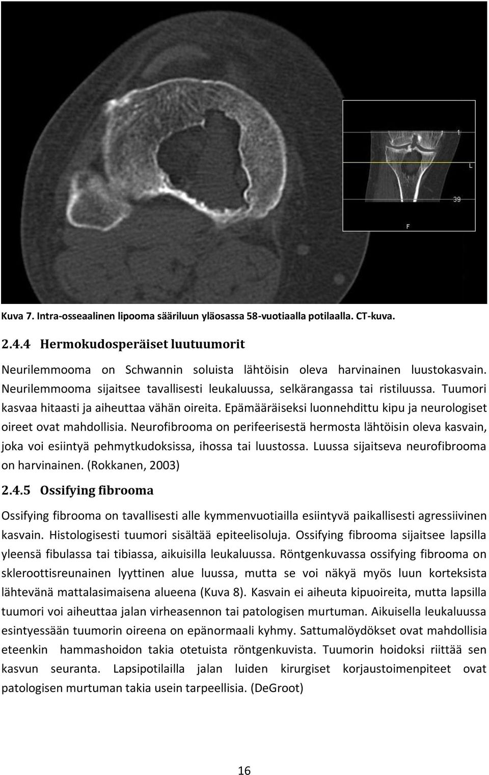 Tuumori kasvaa hitaasti ja aiheuttaa vähän oireita. Epämääräiseksi luonnehdittu kipu ja neurologiset oireet ovat mahdollisia.