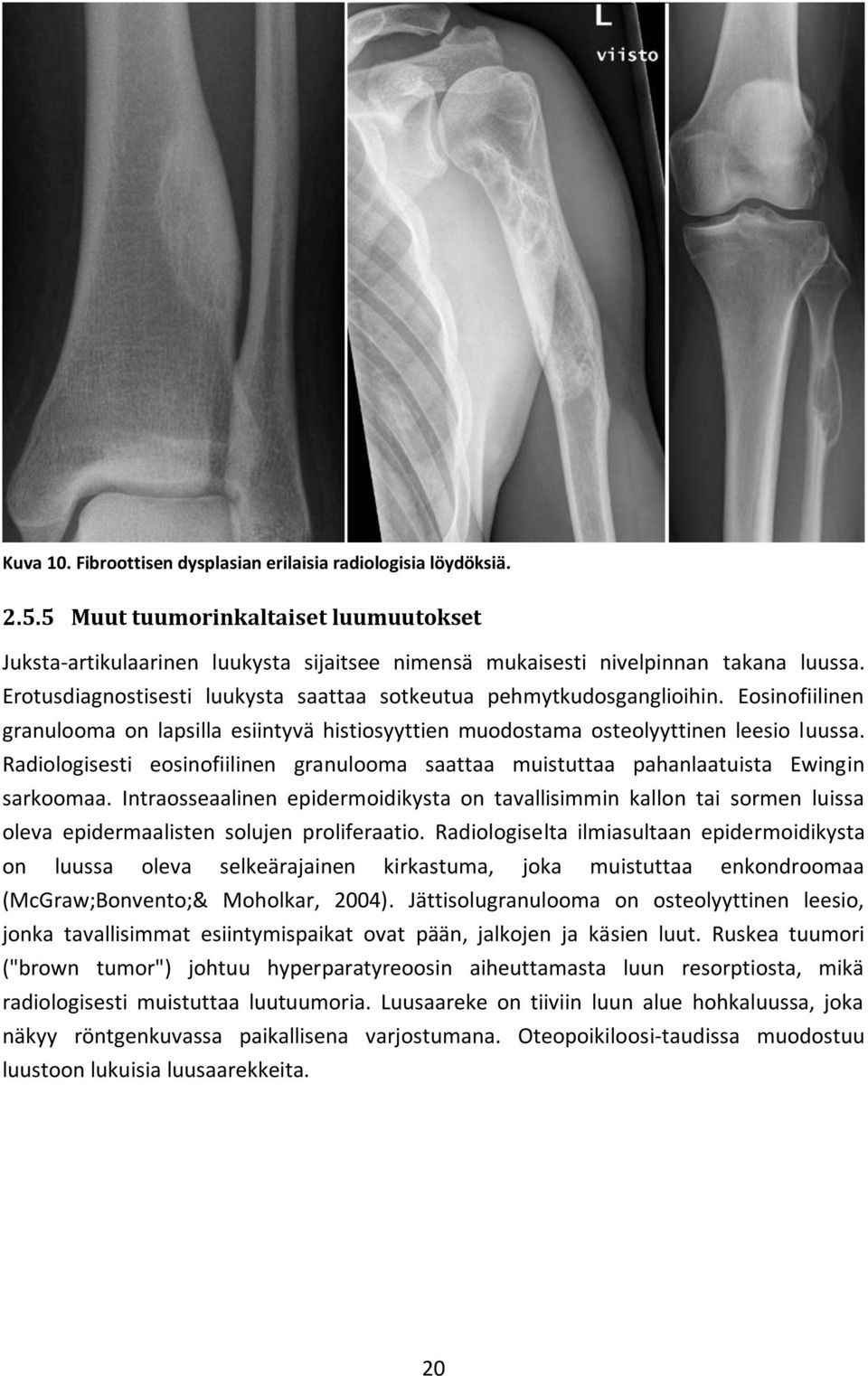 Radiologisesti eosinofiilinen granulooma saattaa muistuttaa pahanlaatuista Ewingin sarkoomaa.